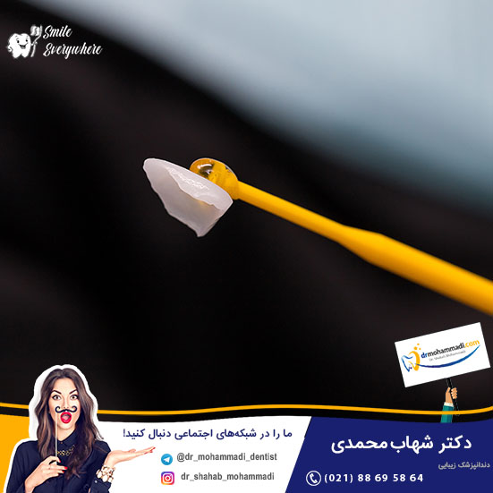 انواع لمینت دندان بر اساس اجزای سازنده آن ، چگونه بهترین نوع لمینت ونیر را انتخاب کنم؟ - کلینیک دندانپزشکی دکتر شهاب محمدی